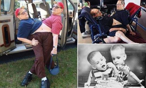 Самые известные пары сиамских близнецов и их судьба