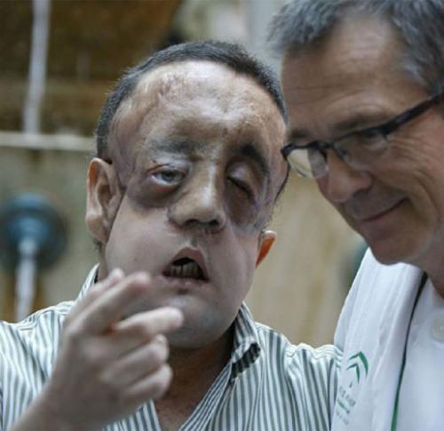 Пациент с пересаженным лицом показался на публике