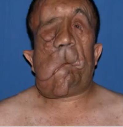 Пациент с пересаженным лицом показался на публике