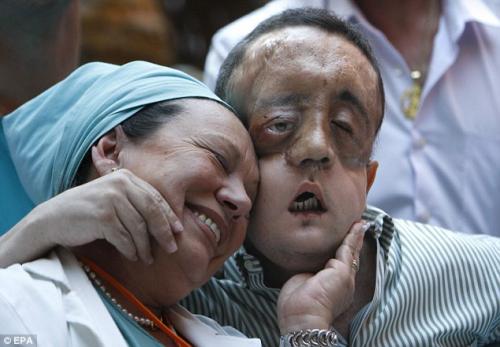 Пациент с пересаженным лицом показался на публике