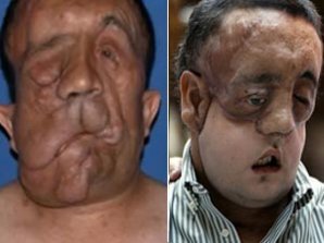 Пациент с пересаженным лицом показался на публике