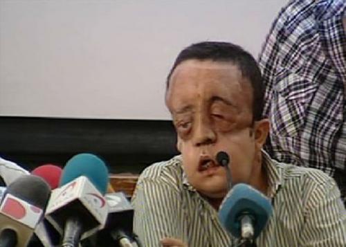 Пациент с пересаженным лицом показался на публике