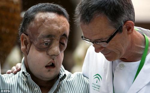 Пациент с пересаженным лицом показался на публике