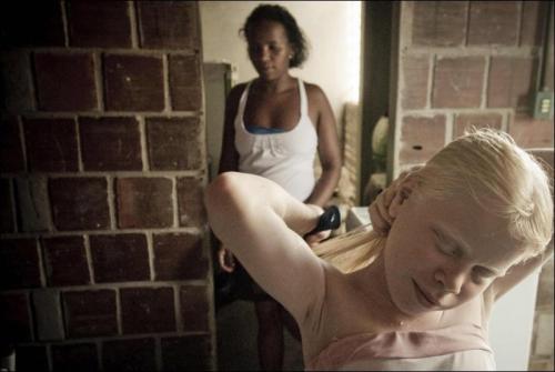 У чернокожих родителей родилось трое детей-альбиносов