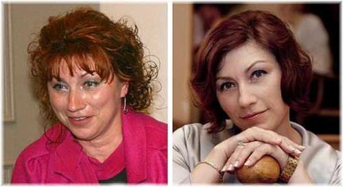 Российские знаменитости до и после пластических операций