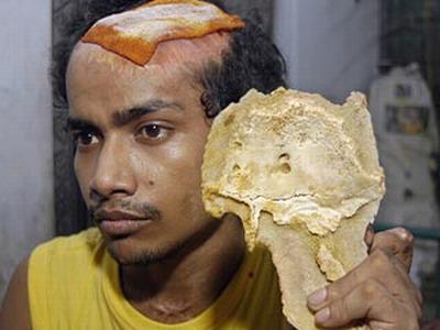 У 25-летнего индуса вырос новый череп