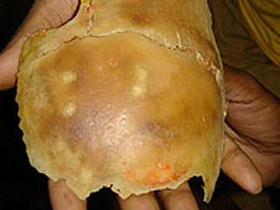 У 25-летнего индуса вырос новый череп