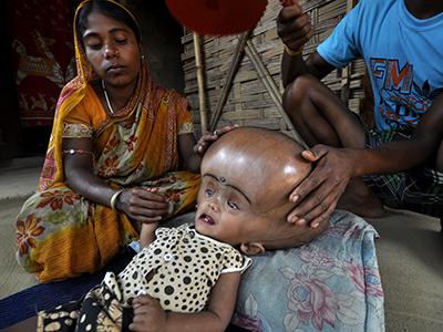Для Индии такие болезни не редкость из-за бедности большинства местного населения и ужасных антисанитарных условий жизни.