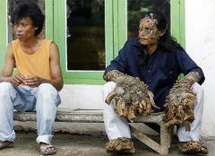 «Человек – дерево» почти исцелен