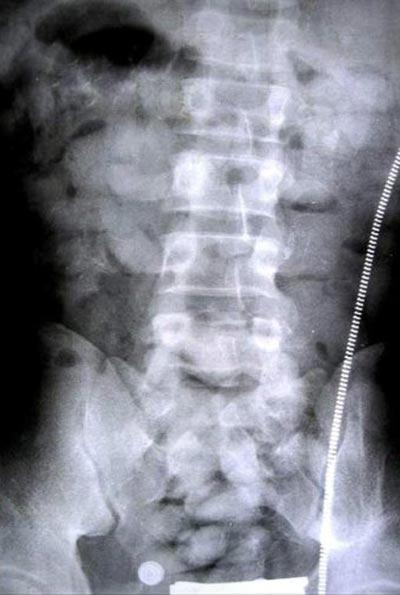 Самые невероятные случаи контрабанды наркотиков