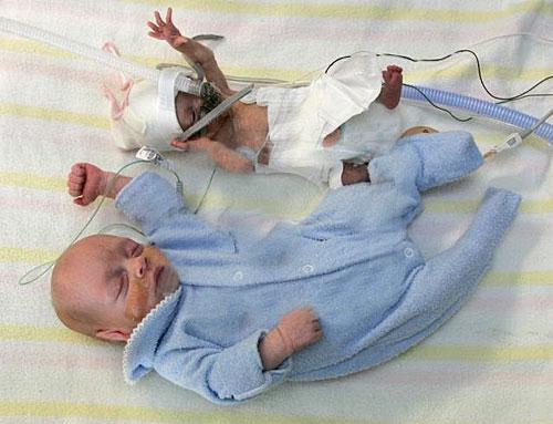 Один брат-близнец перерос другого в три раза