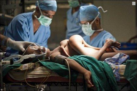 Мальчик с близнецом в груди перенес успешную операцию