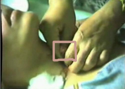 Разоблачение филиппинских хилеров: как делаются операции без скальпеля