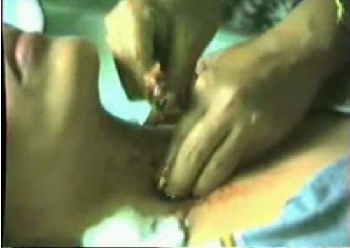 Разоблачение филиппинских хилеров: как делаются операции без скальпеля
