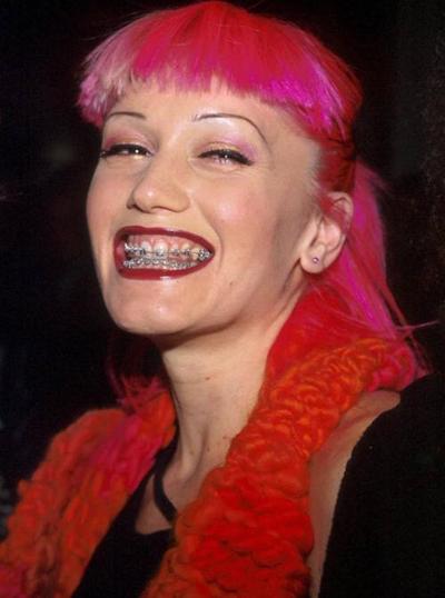 Звездные брекеты