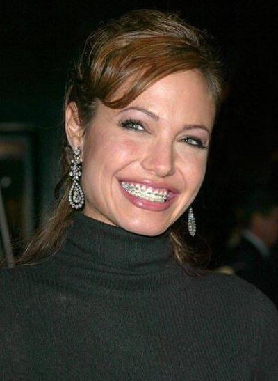 Звездные брекеты