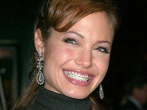 Звездные брекеты