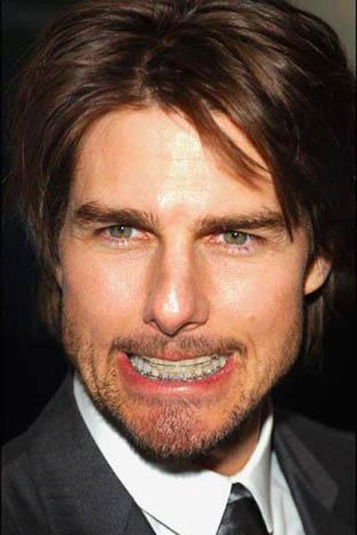 Звездные брекеты