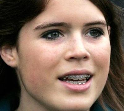 Звездные брекеты