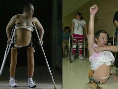 Китаец, разрезанный пополам 13 лет назад, учится ходить