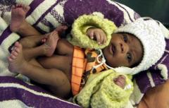 В Замбии родился ребенок с четырьмя ногами
