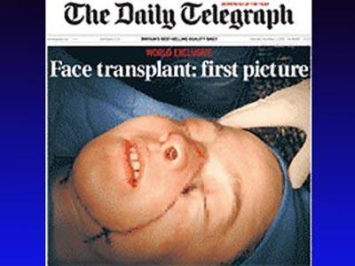 Британским хирургам разрешили операции по пересадке лица