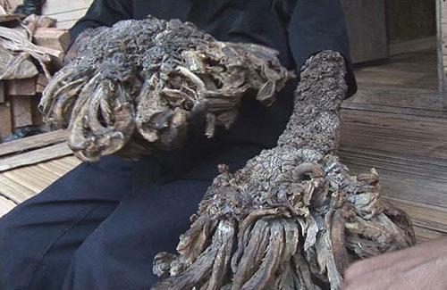 "Человек-дерево" из Индонезии намерен жениться