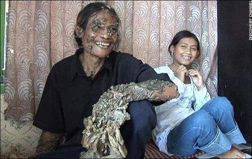 "Человек-дерево" из Индонезии намерен жениться