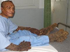 "Человек-дерево" из Индонезии намерен жениться