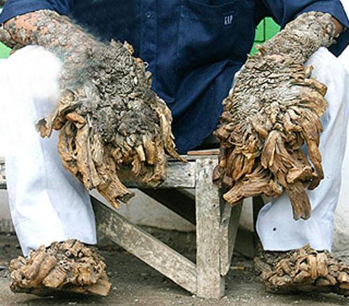 "Человек-дерево" из Индонезии намерен жениться