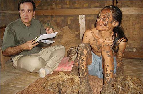 "Человек-дерево" из Индонезии намерен жениться