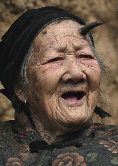 У 101-летней китаянки вырос рог