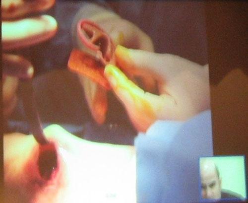 Человек, который вживил ухо в собственную руку