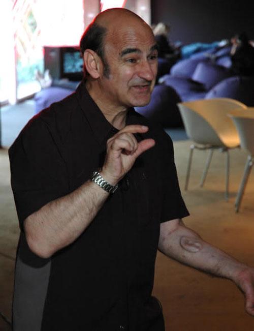 Человек, который вживил ухо в собственную руку