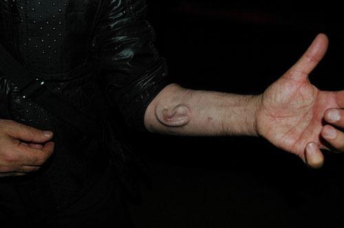 Человек, который вживил ухо в собственную руку