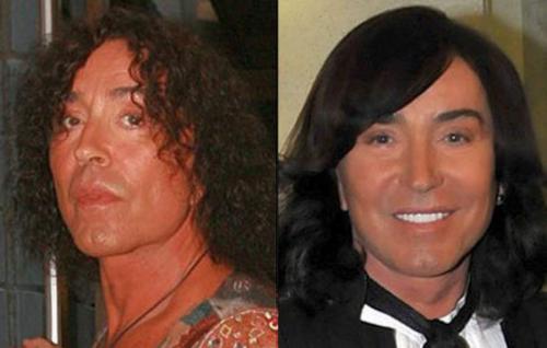 Российские звезды, переборщившие с пластикой