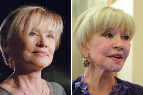 Российские звезды, переборщившие с пластикой