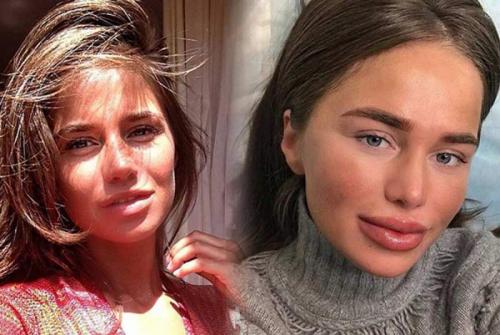 Российские звезды, переборщившие с пластикой