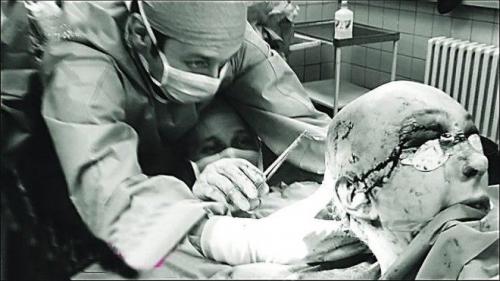Самые невероятные операции на голове человека