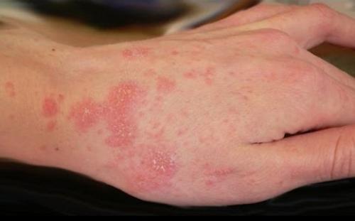 10 самых страшных паразитов, которые могут жить в человеческом теле