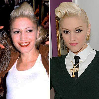 Пластические операции звезд: до и после