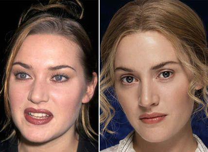 Пластические операции звезд: до и после