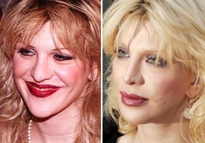 Пластические операции звезд: до и после