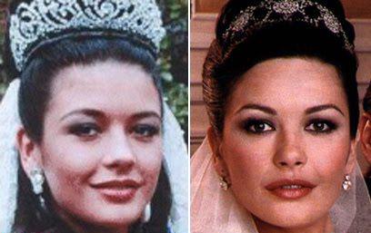 Пластические операции звезд: до и после