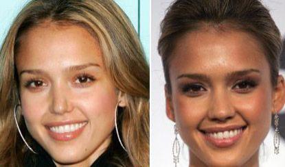 Пластические операции звезд: до и после