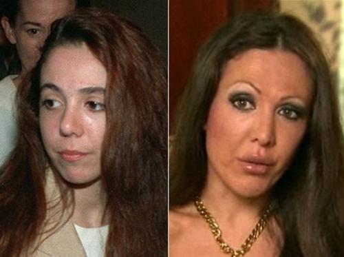 Звезды, перестаравшиеся с пластикой и  ботоксом: до и после