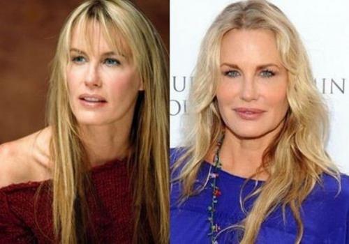 Звезды, перестаравшиеся с пластикой и  ботоксом: до и после