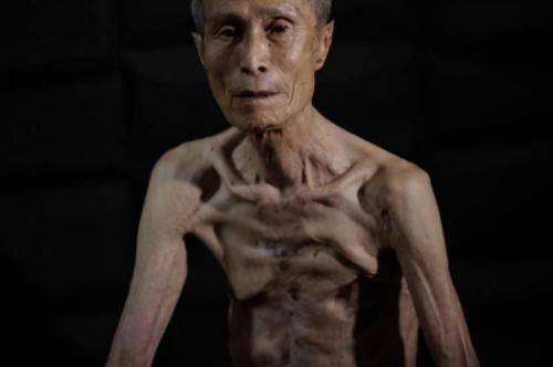 Японец показал шрамы после взрыва атомной бомбы 70 лет назад