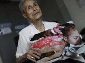 Японец показал шрамы после взрыва атомной бомбы 70 лет назад