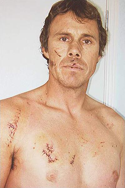 Выжившие после встречи с акулой: реальные фотосвидетельства